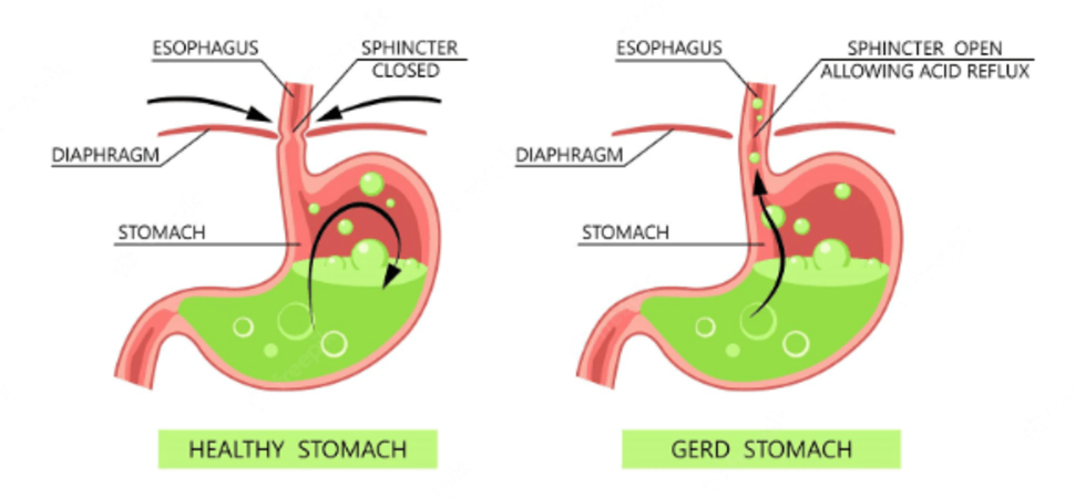 Can GERD Be Cured Online Pharmacy in the UK